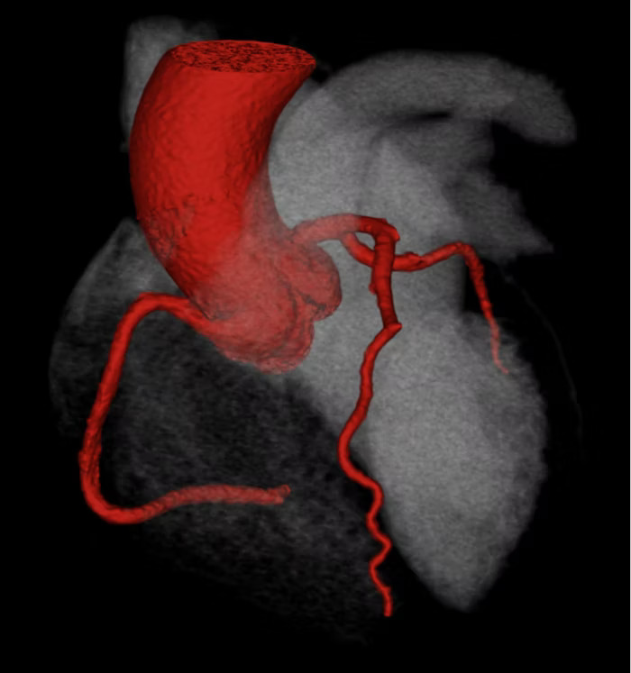3D reconstruction of a CT coronary angiogram